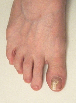 Healthy toenail growth appears after three 
                    weeks of treatment